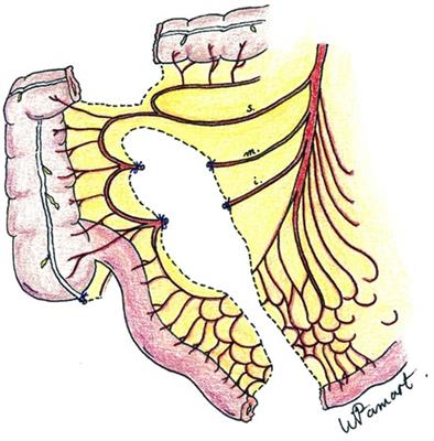 Long-term follow-up after retrosternal ileocolic esophagoplasty in two cases of long-gap esophageal atresia: why it is still a valid option as a rescue strategy